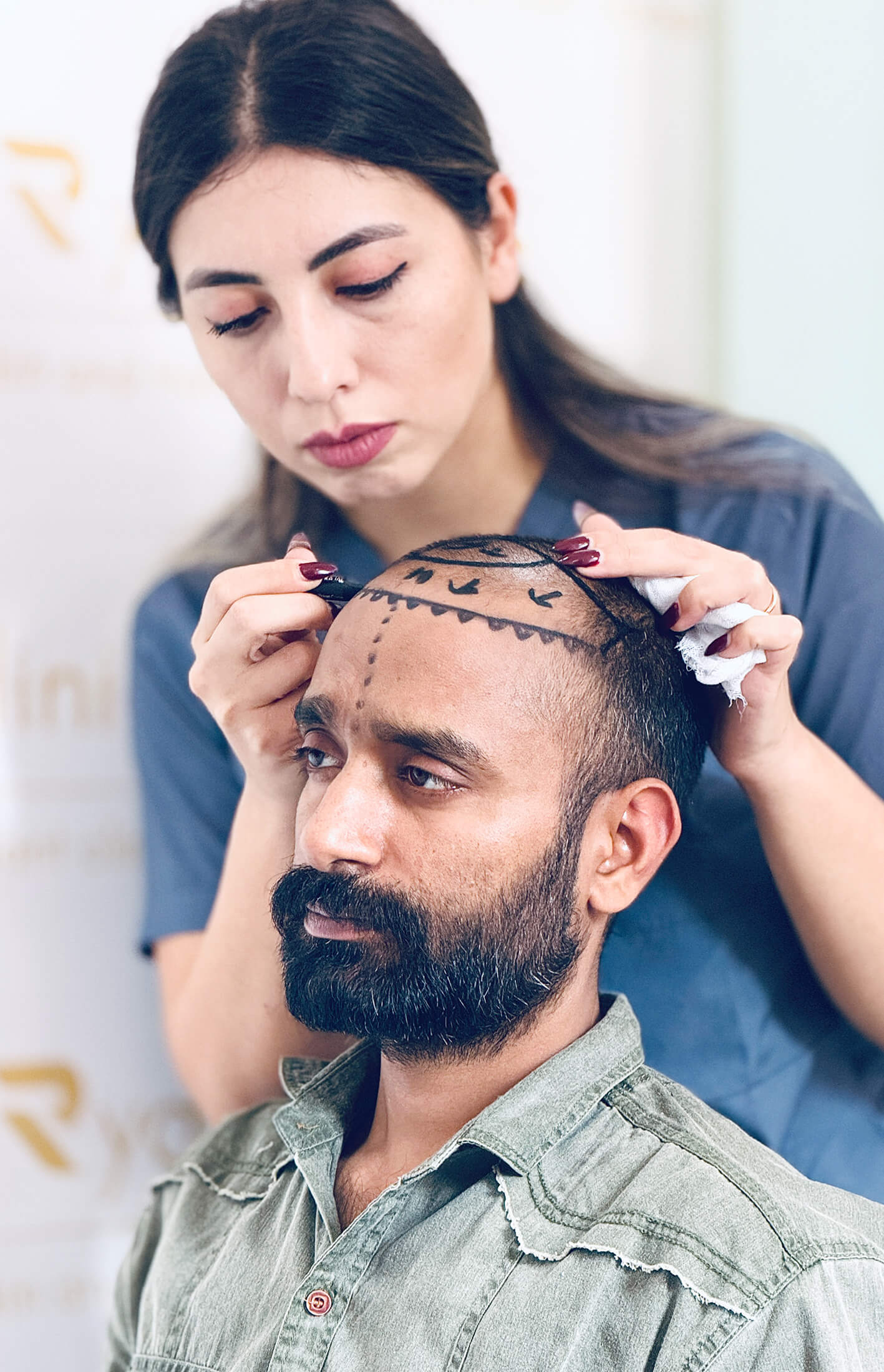 Hair transplant results Chennai